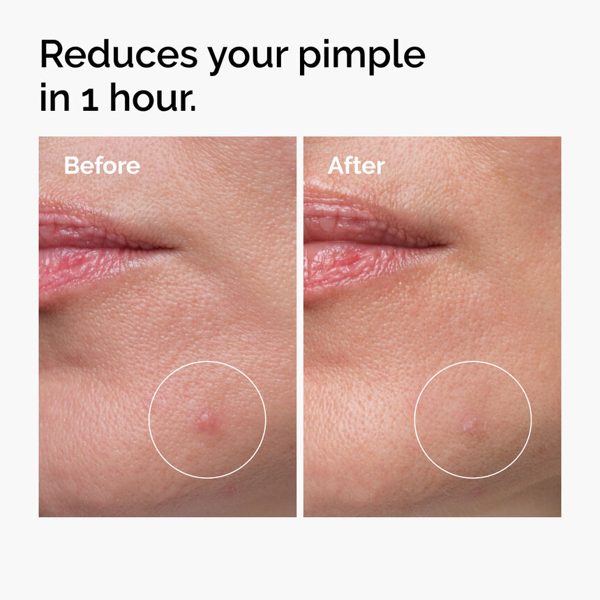 ACNE GONE