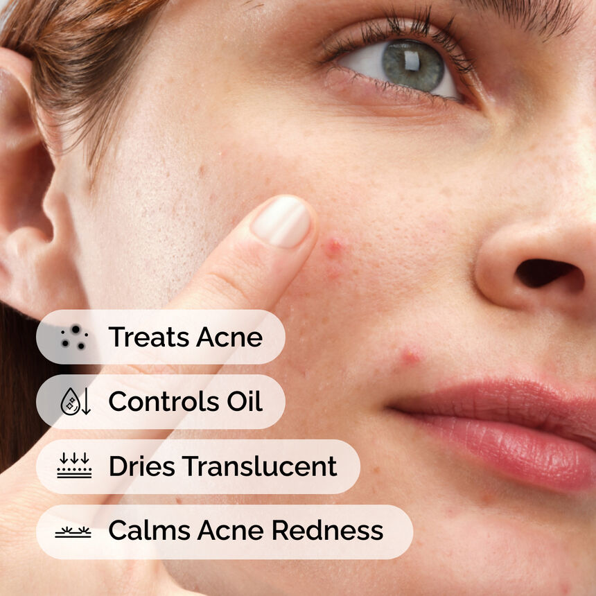 ACNE GONE